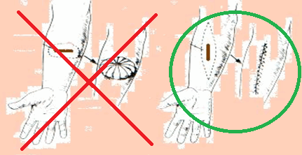 Ошибки иссечения меланомы