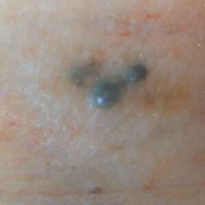 Другие виды лечения - меланома на щеке