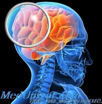 внутричерепные гематомы