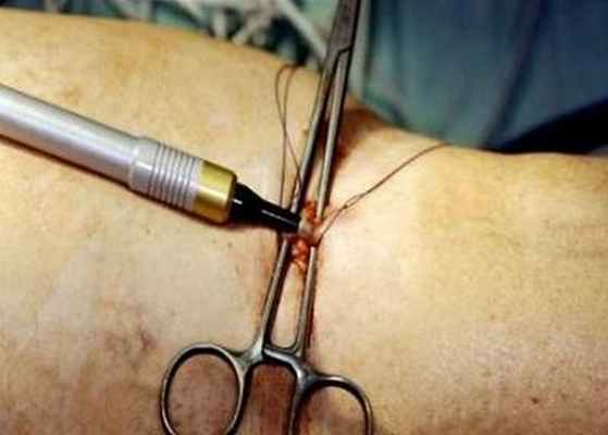 Криостриппинг - удаление варикоза холодом