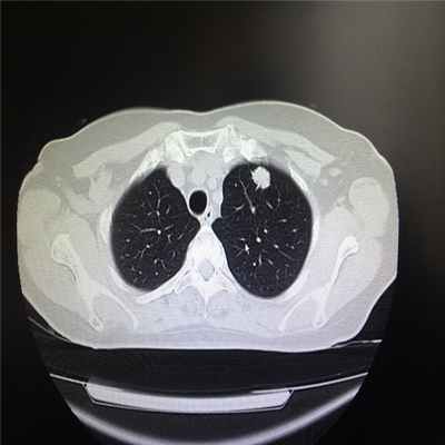 Периферическая опухоль верхней доли левого легкого (компьютерная томография)