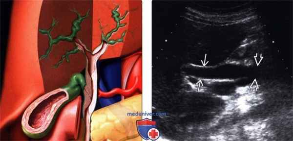 УЗИ при СПИД-ассоциированной холангиопатии