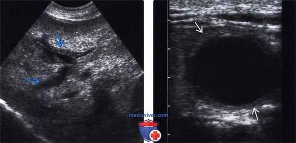 УЗИ при СПИД-ассоциированной холангиопатии