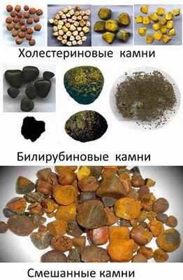 Камни в желчном пузыре
