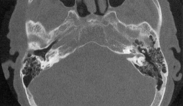 КТ височной кости