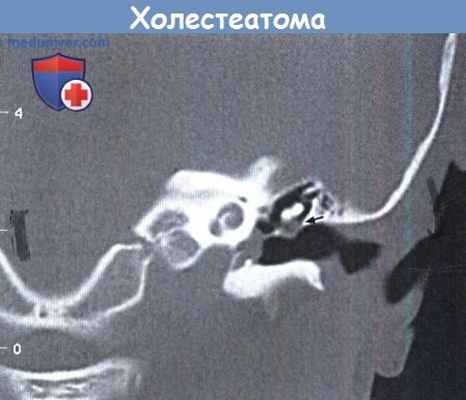 Врожденная холестеатома височной кости