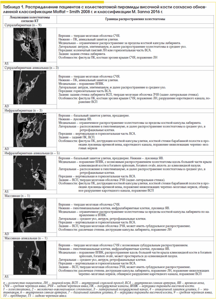 Таблица 1. Распределение пациентов с холестеатомой пирамиды височной кости согласно обновленной классификации Moffat – Smith 2008 г. и классификации M. Sanna 2016 г.