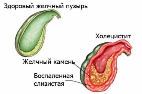 холецистит