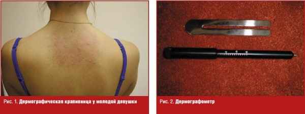 Дермографическая крапивница у молодой девушки