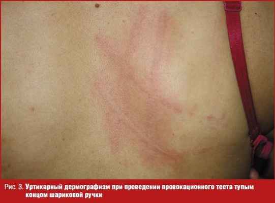 Уртикарный дермографизм при проведении провокационного теста тупым концом шариковой ручки