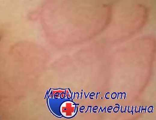 холодовая крапивница