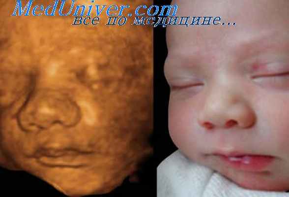 сердце новорожденных