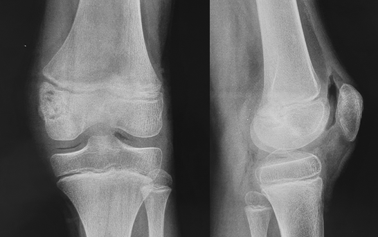 КТ Хондробластома