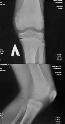 Хондробластома дистального эпифиза левой бедренной кости.
