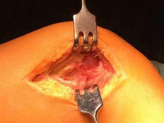 Операция: субхондральная резекция дистального эпифиза левой бедренной кости, электрокоагуляция, аутопластика. 