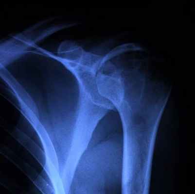 Хондробластома головки левой плечевой кости