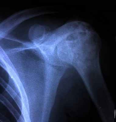 Хондробластома левой плечевой кости