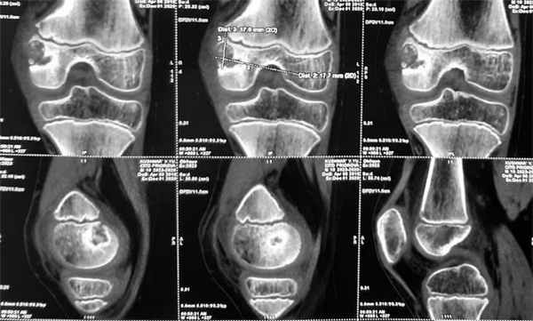 Злокачественная хондробластома