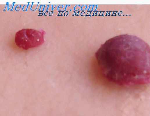 хондросаркома