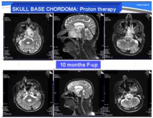 Хондрома и Хондросаркома