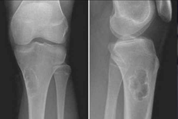 хондромиксоидная фиброма