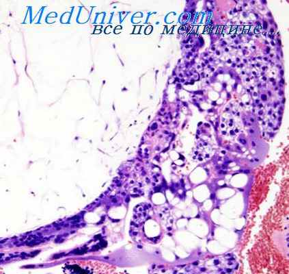 хорионэпителиома