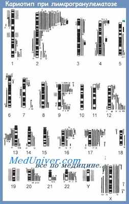 кариотип при лимфогранулематозе