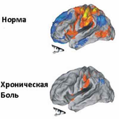 Хроническая боль