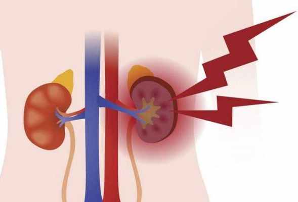 хроническая почечная недостаточность (ХПН)