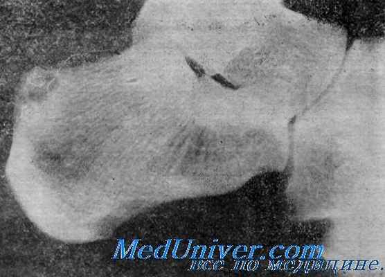 микротравма костной ткани