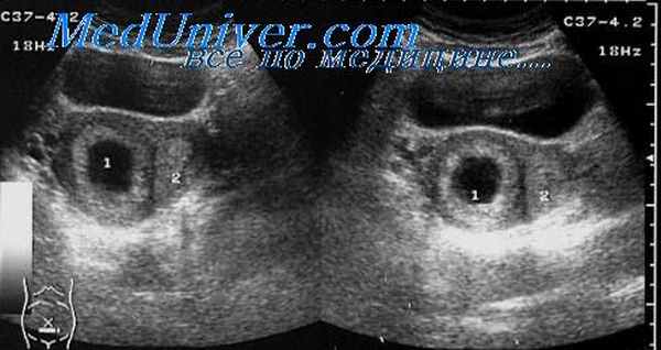 хроническая внематочная беременность