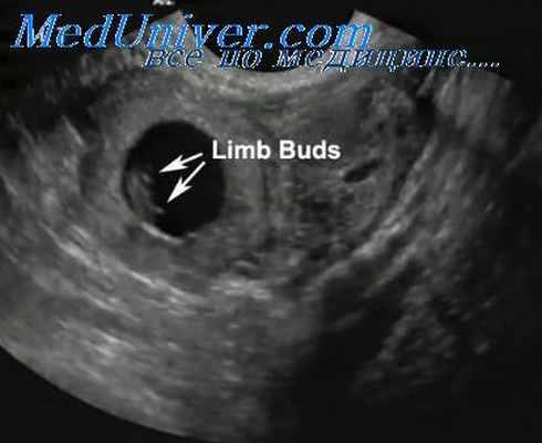 внематочная беременность