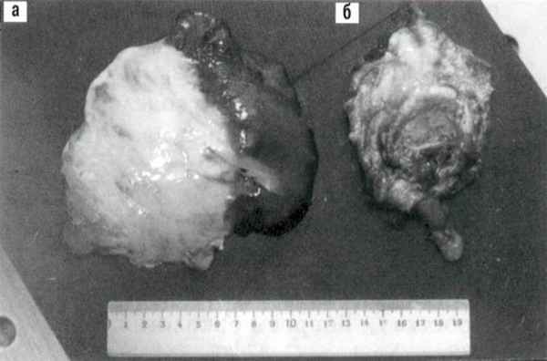 Мукоцеле червеобразного отростка - макропрепарат (а - слизистое содержимое кисты, б - стенка кисты)