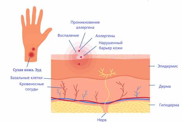 Кожа и дерматит.jpg