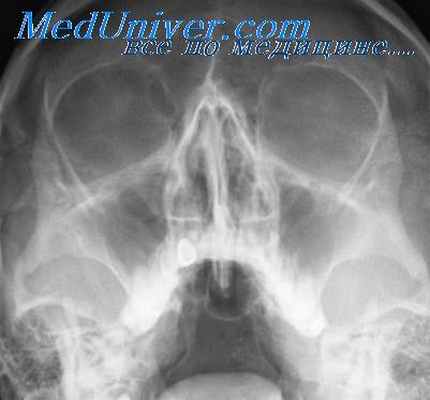 рентгенография при этмоидите