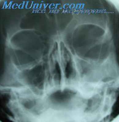 хронический фронтит