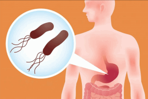 лечение эрозивного гастрита