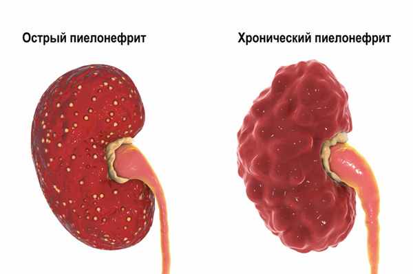 Пиелонефрит_острый_хронический.jpg