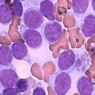 Хронический лимфолейкоз