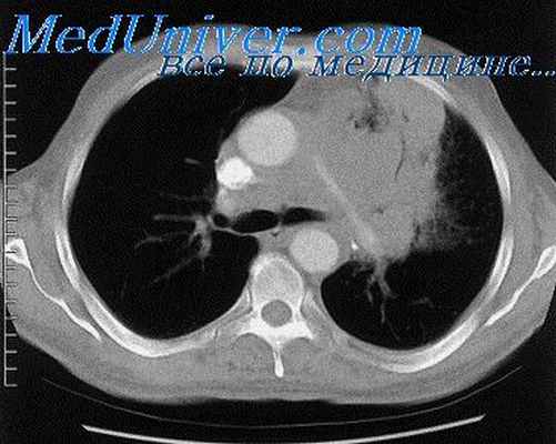 медиастинит