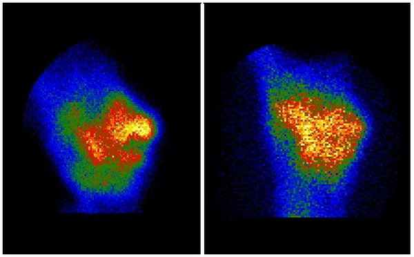Рис. 3. Сцинтиграммы пациентки К., 49 лет, при поступлении (слева) и через 18 дней (справа). Перераспределение накопления радиофармпрепарата непосредственно в области щели ложного сустава