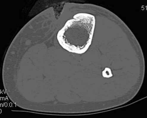 Рис. 5. Компьютерная томограмма левой голени пациентки Н., 18 лет с хроническим посттравматическим остеомиелитом. Определяется деструкция передней части компактной пластины большеберцовой кости