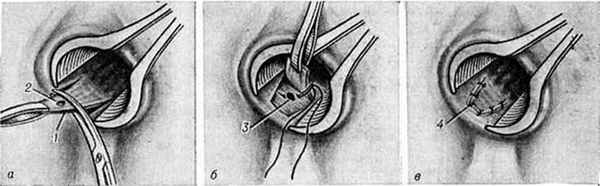 хирургическое вмешательство при лечении парапроктита