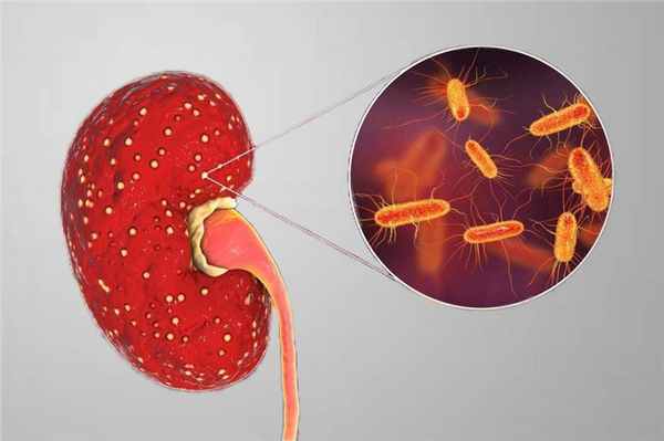 хронический пиелонефрит