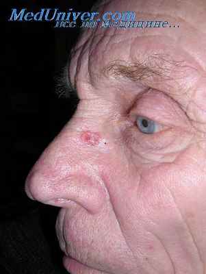 радиационный рак кожи