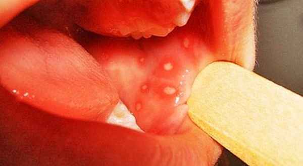 Хронический герпетический стоматит