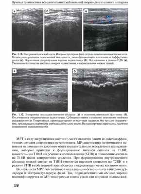 Рис. 1.12. Эхограммы поднадкостничного абсцесса
