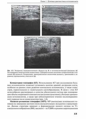 Рис. 1.5. Эхограммы поднадкостничного абсцесса