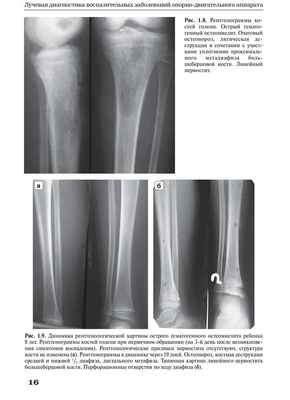 Рис. 1.9. Динамика рентгенологической картины острого гематогенного остеомиелита ребенка