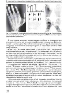 Рис. 1.2. Остеомиелит III пястной кости